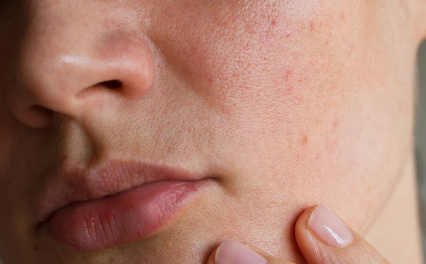 Pores & Sébum
